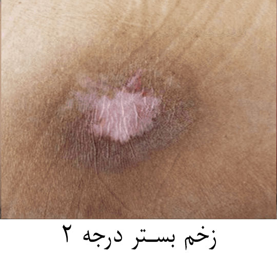 زخم بستر درجه 2