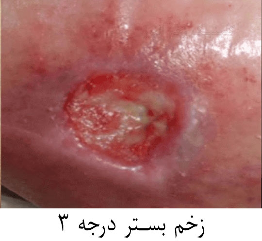 زخم بستر درجه 3