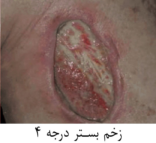زخم بستر درجه 4