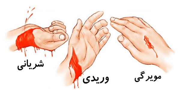 کمک های اولیه خونریزی
